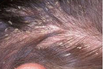 scalp disorder