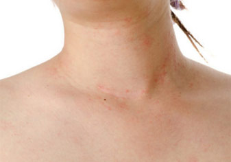 affected areas of eczema