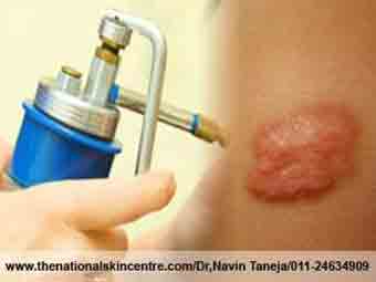 Keloid Removal Treatment