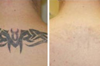 benifits and risks of laser tattoo removal