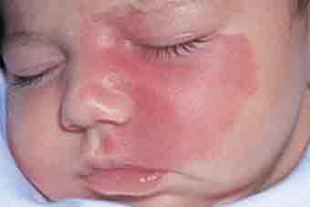 types of birthmark