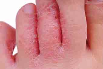 what is skin fungal