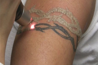 process of tattoo removal